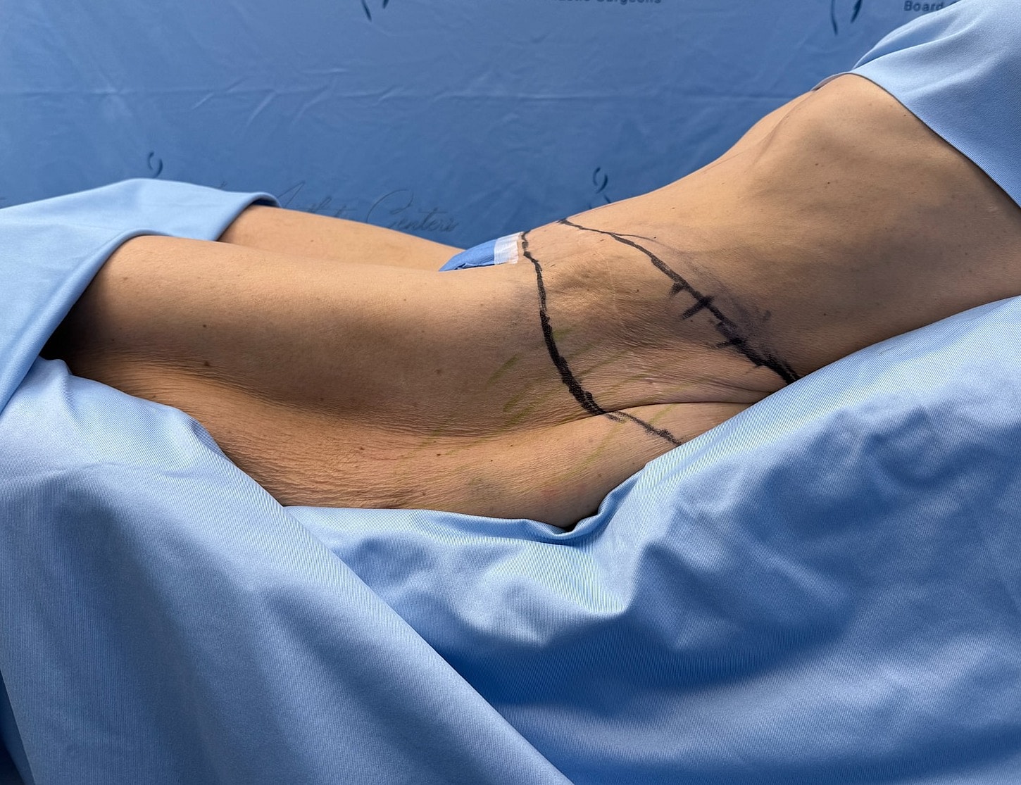 Surgical markings on a patient's torso pre-procedure.