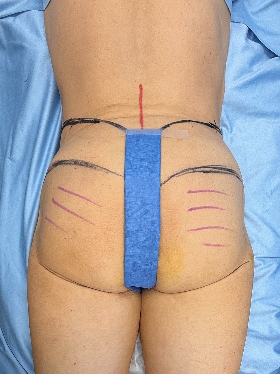Body marking for cosmetic procedure preparation.