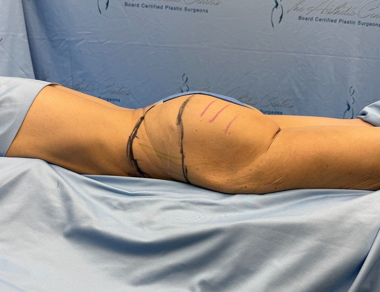 Patient arm with surgical markings and draping.