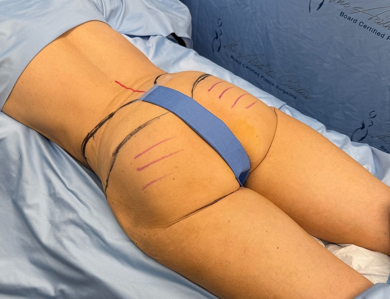 Patient preparation for body contouring procedure.