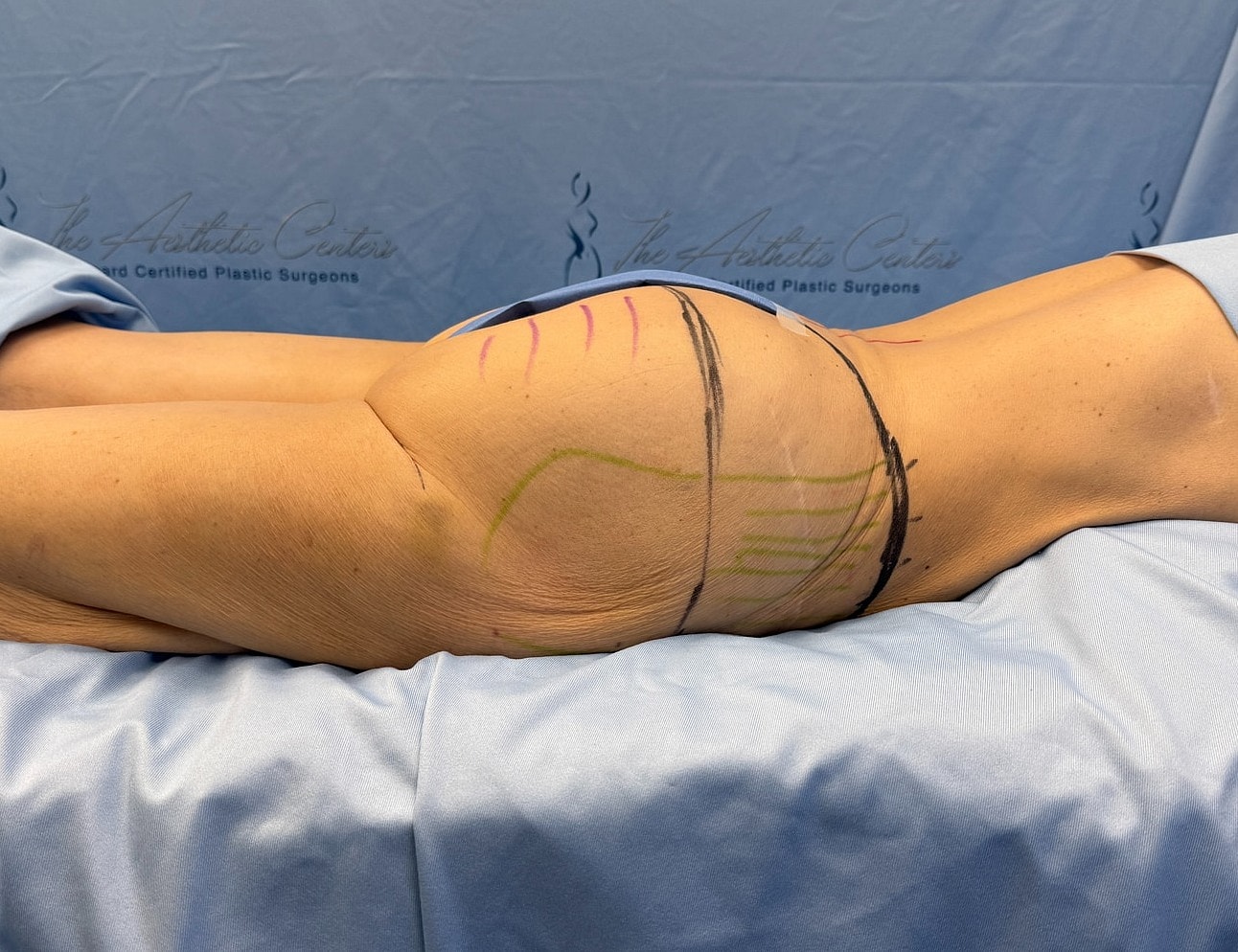 Body contouring markings on patient before procedure.