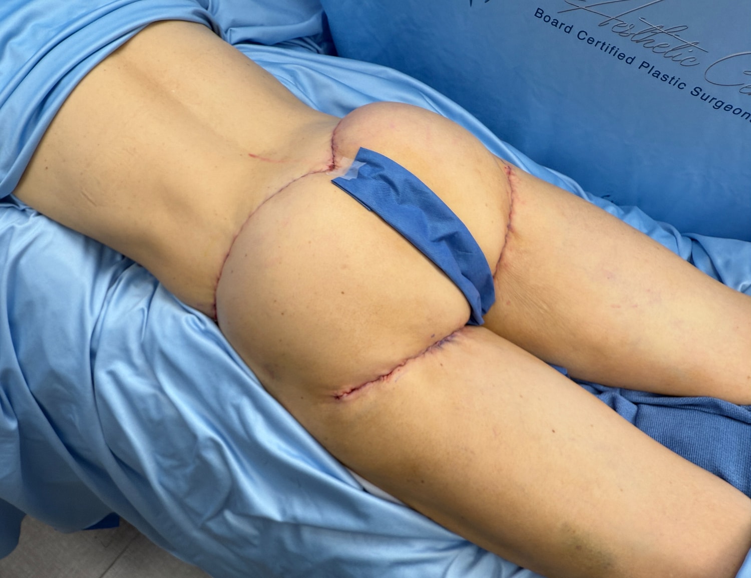 Post-surgical buttock augmentation recovery stage.