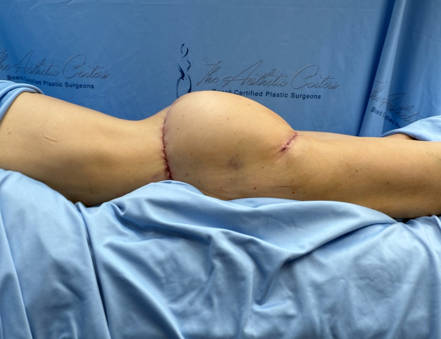 Post-surgery body with surgical scars visible.