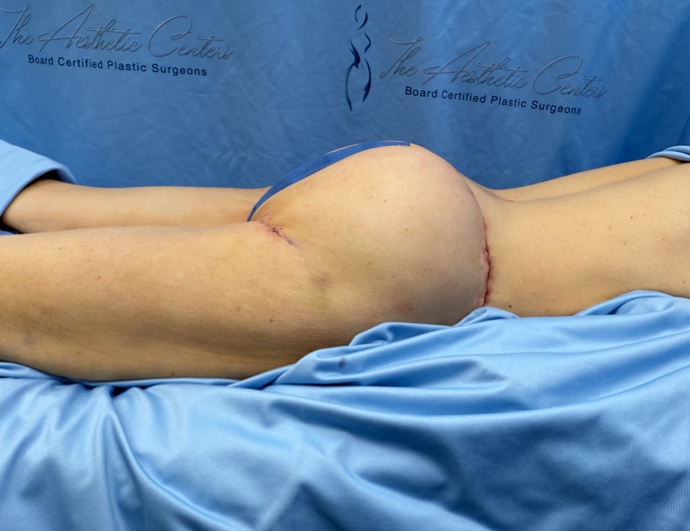 Post-surgery view of buttock enhancement procedure.