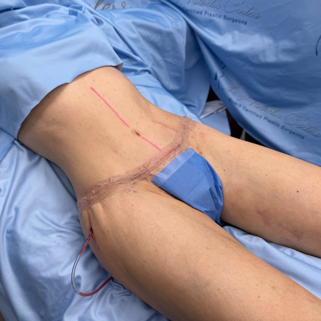 Patient preparing for surgery with markings.