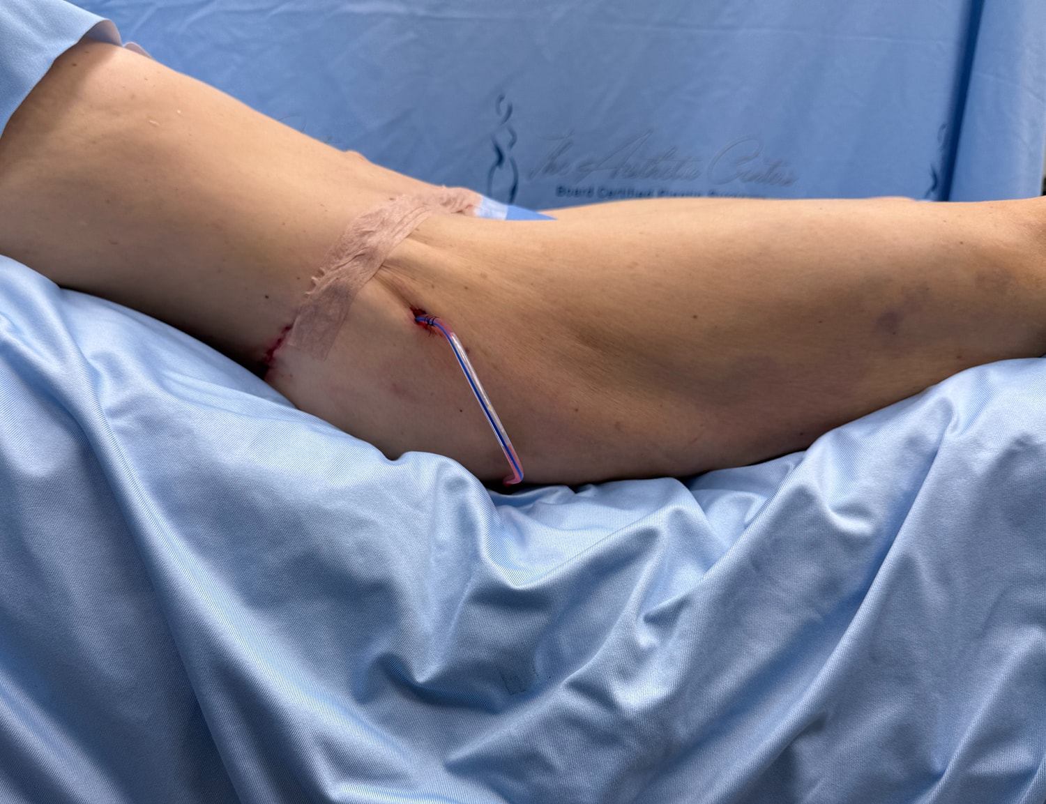 Surgical site on patient’s leg with tube.
