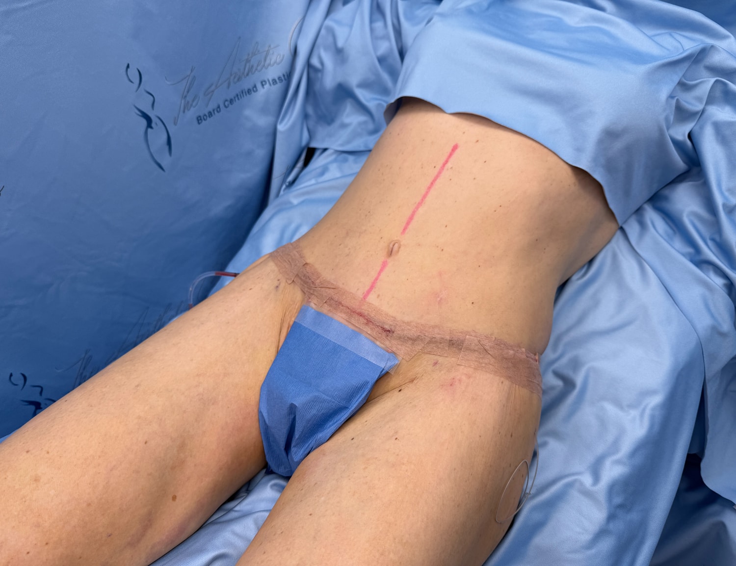 Surgical preparation for procedure on lower abdomen.