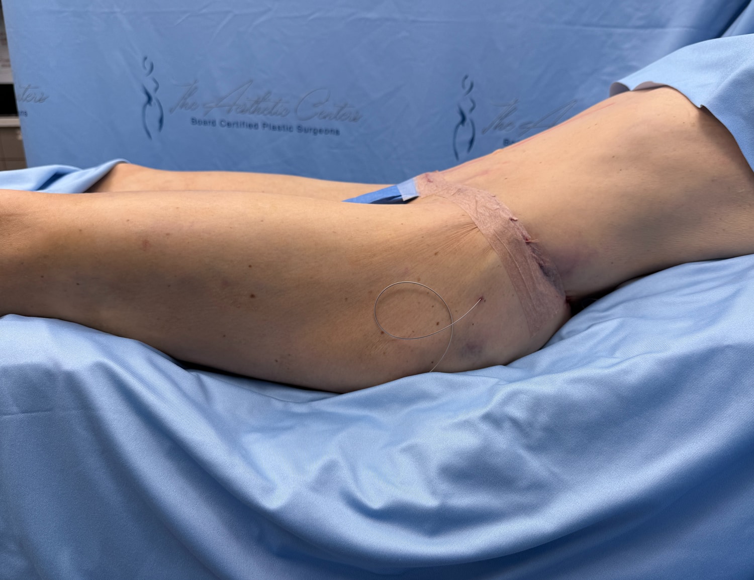 Patient's leg with surgical dressing visible.