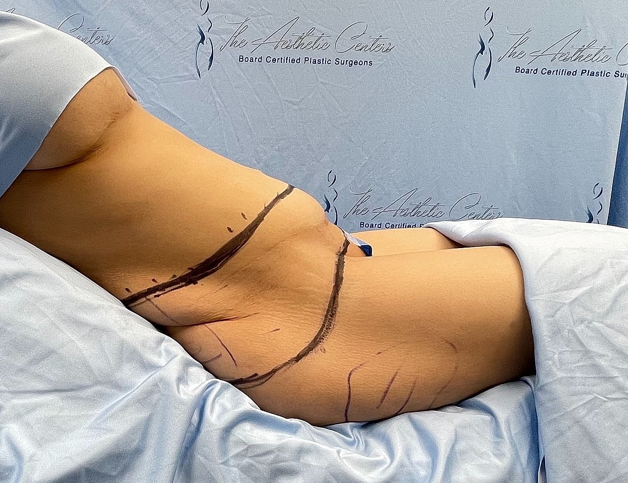 Patient preparation for body contouring procedure.