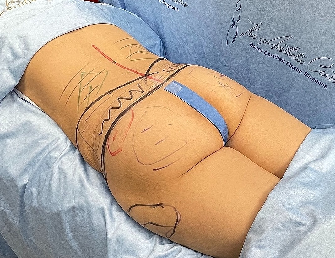Body marking for cosmetic procedure preparation.