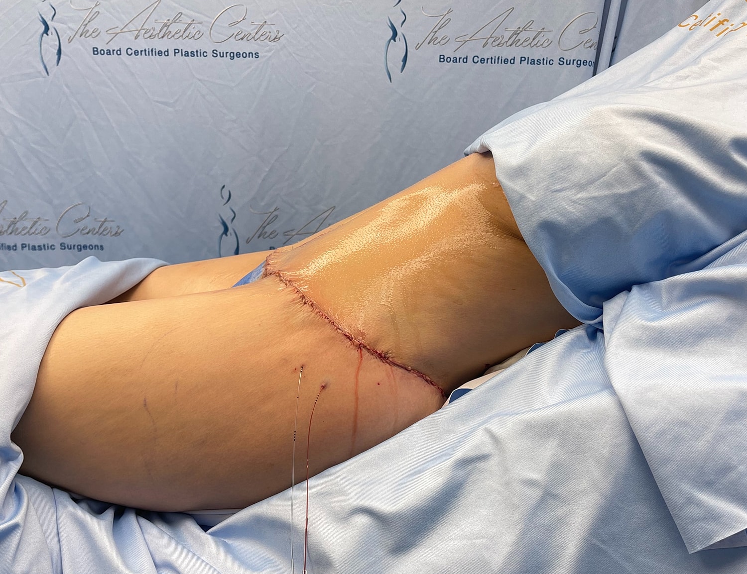Surgical area with incision on patient’s side.
