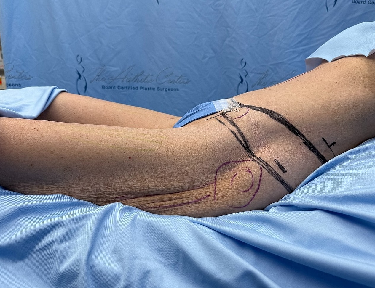Surgical markings on a patient's arm pre-procedure.
