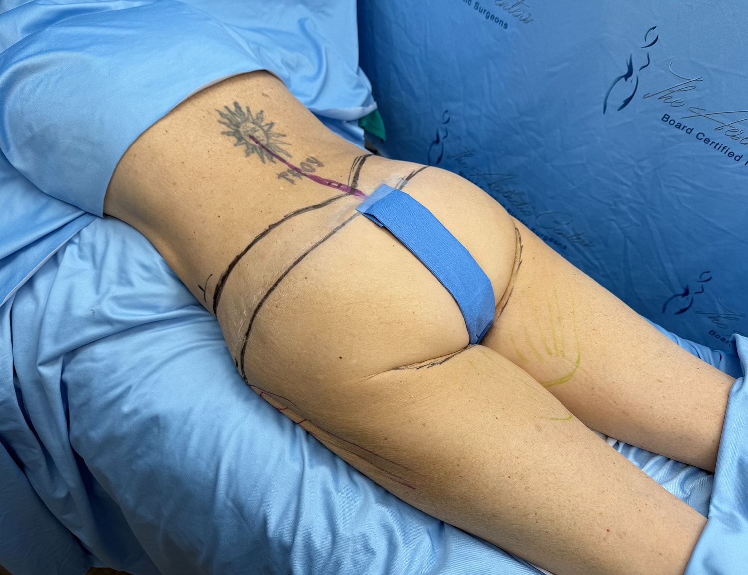Patient preparation for cosmetic body surgery procedure.