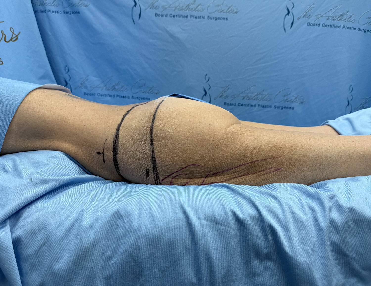 Surgical markings on a patient's side.