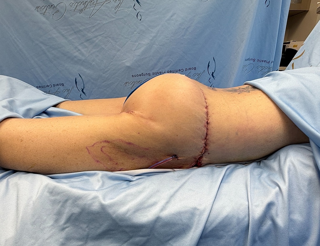Surgical procedure on patient's hip area.