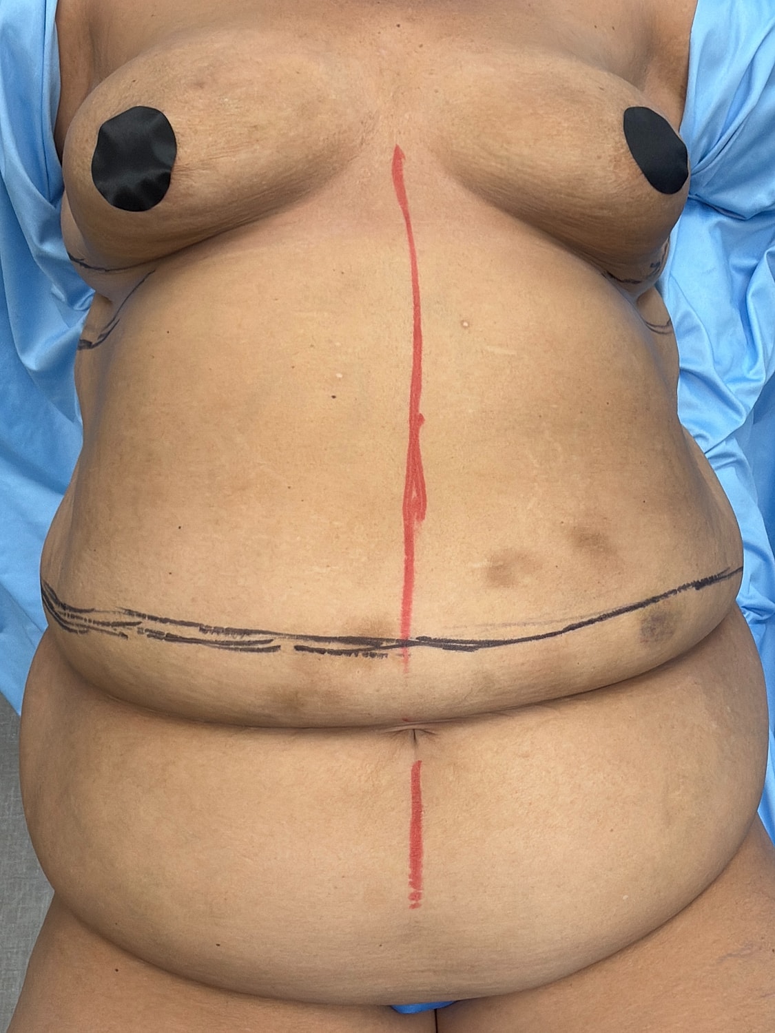 Abdomen with markings for medical procedure.