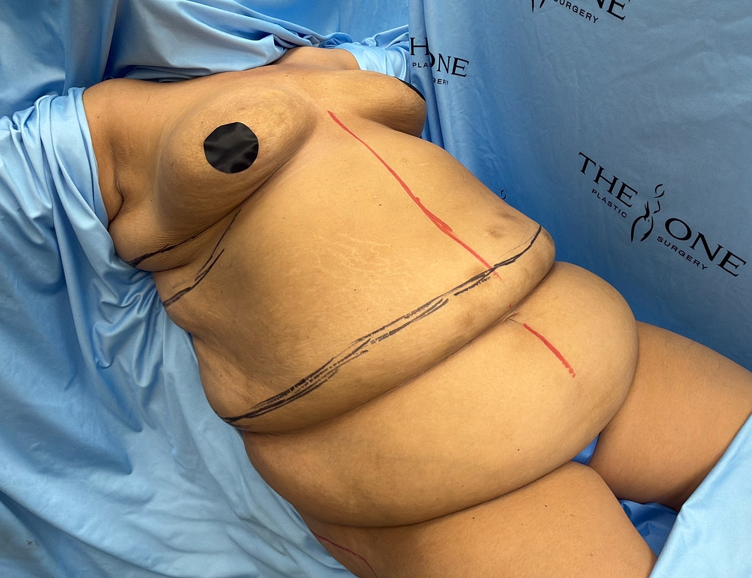 Surgical body model with markings on fabric.
