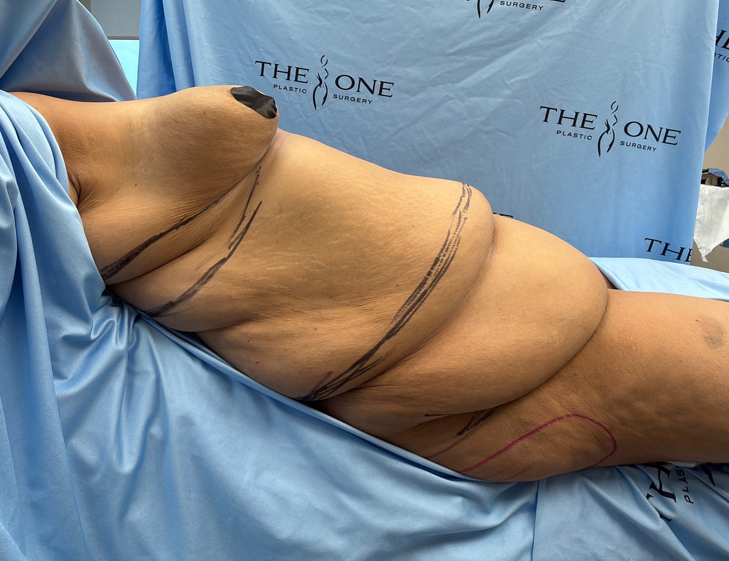 Body contouring pre-surgery markings on patient.