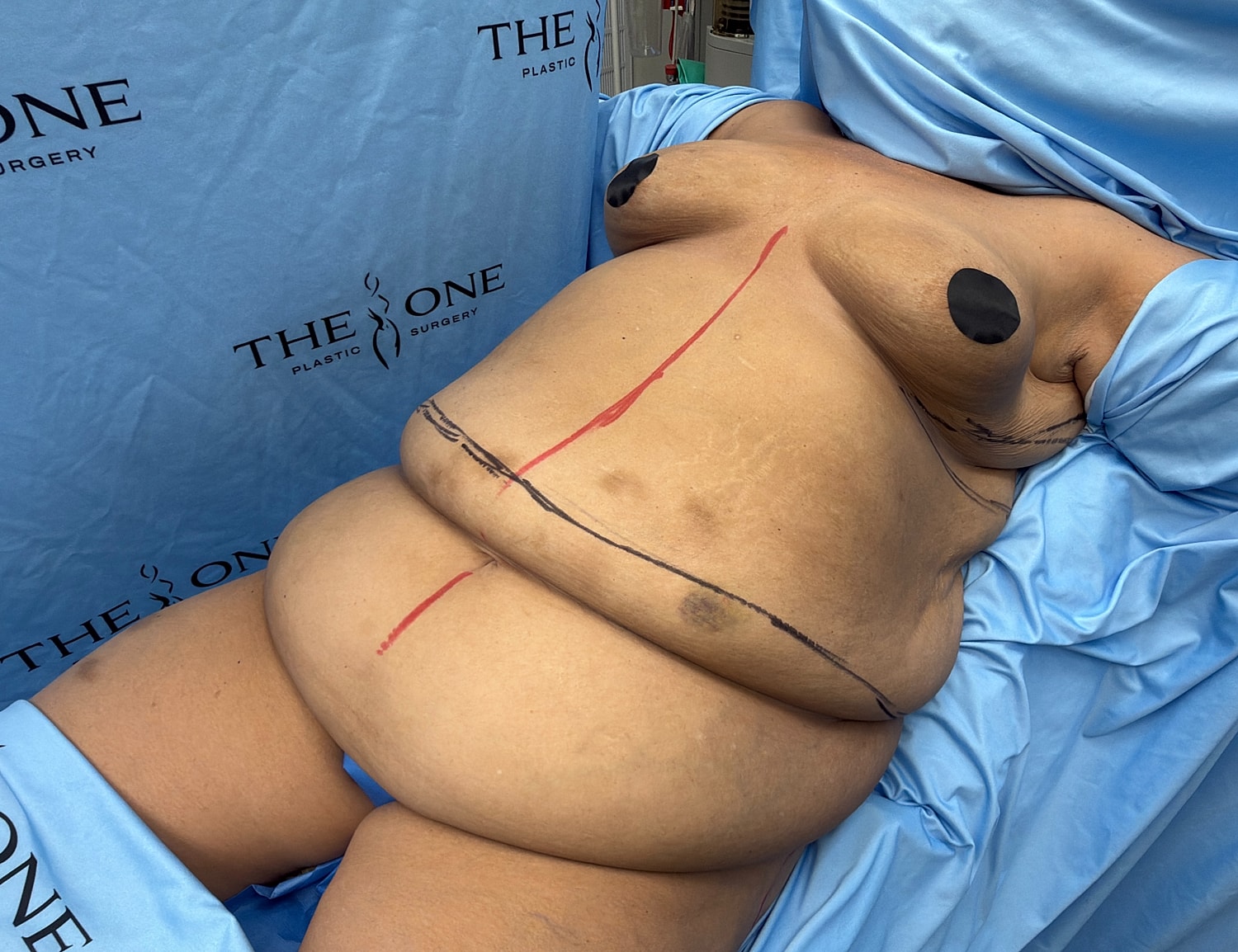 Pre-surgery markings on patient’s abdomen.