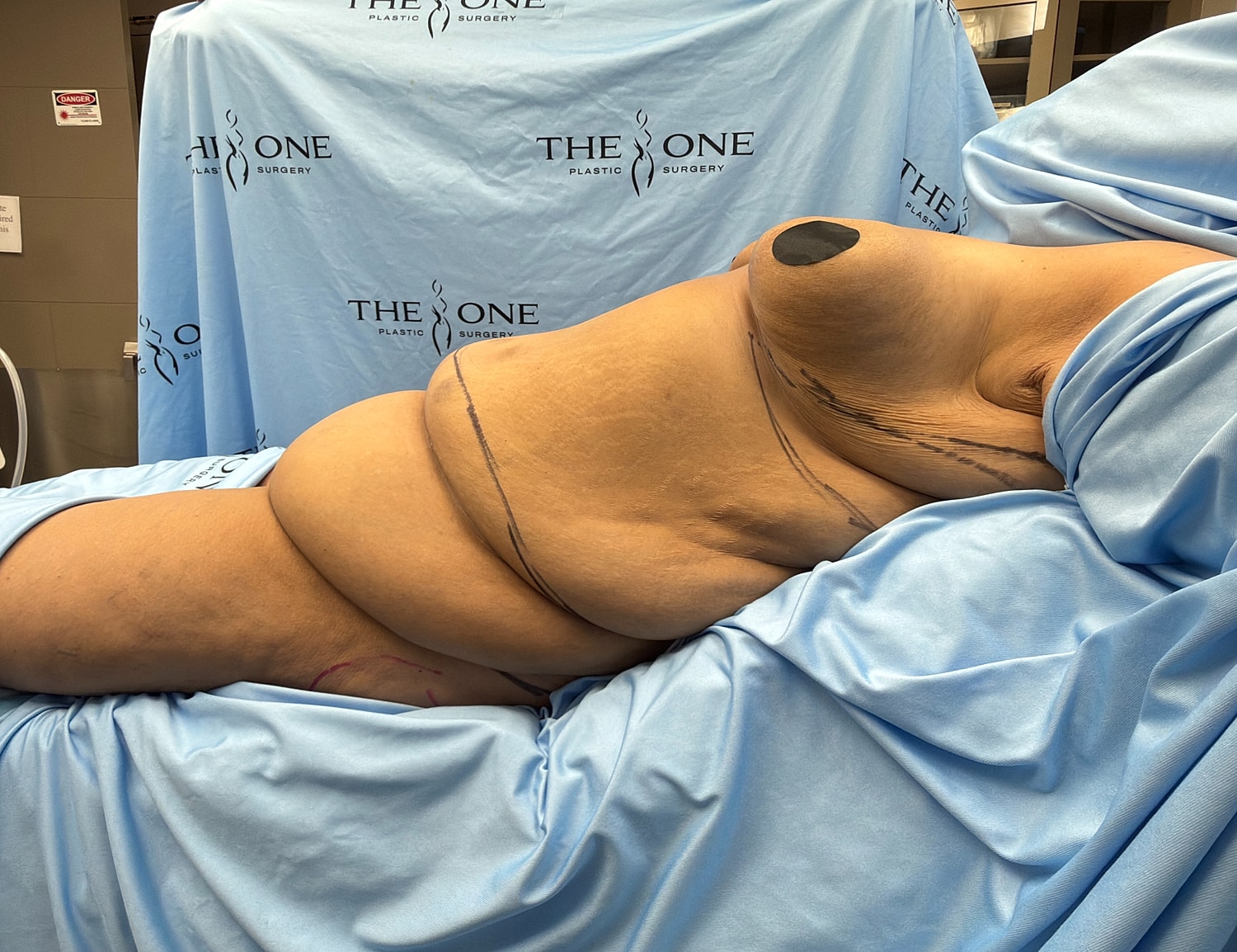 Surgical preparation for body contouring procedure.