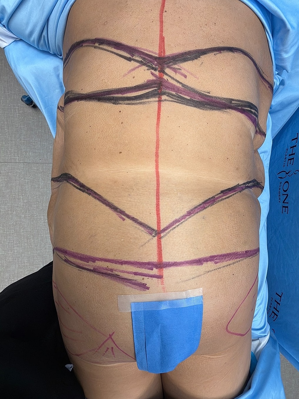 Patient's back marked for surgery preparation.