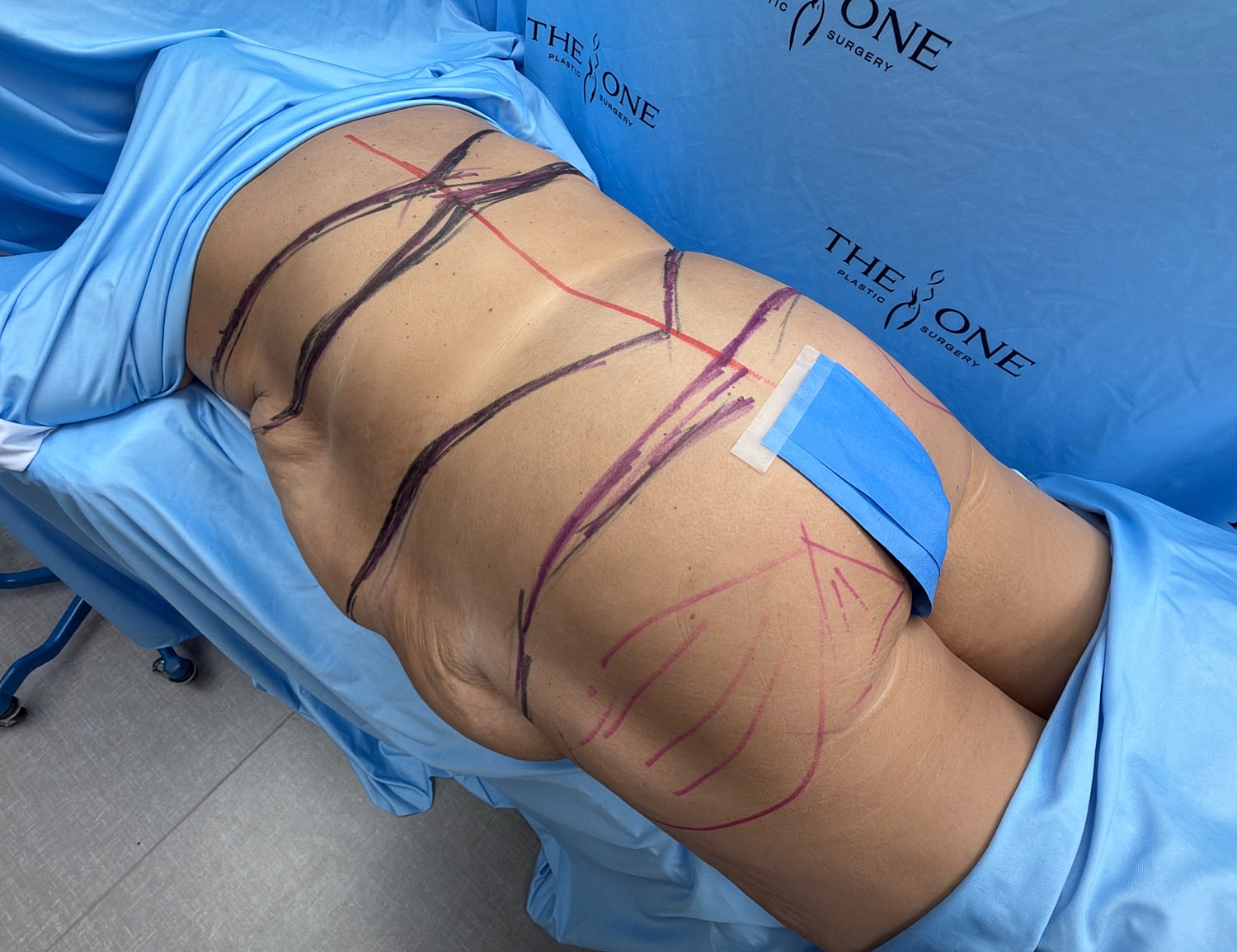 Pre-operative markings on a patient's back.