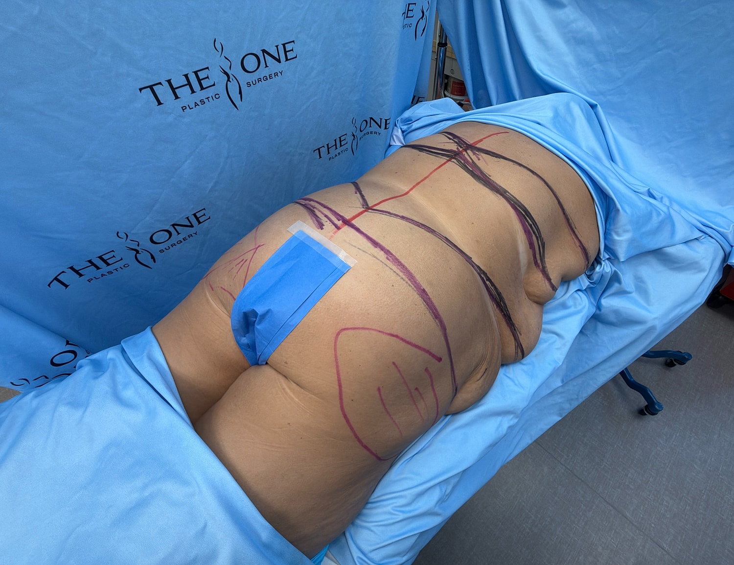 Patient preparation for plastic surgery procedure.