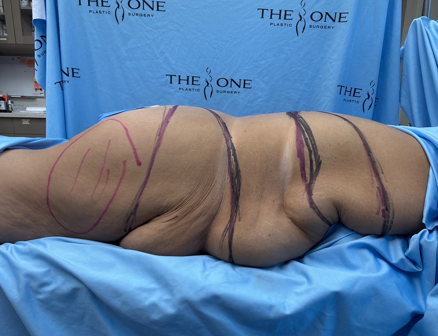 Surgical markings on a patient's body.