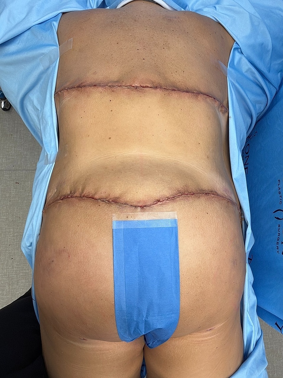 Surgical scars on human back after procedure.