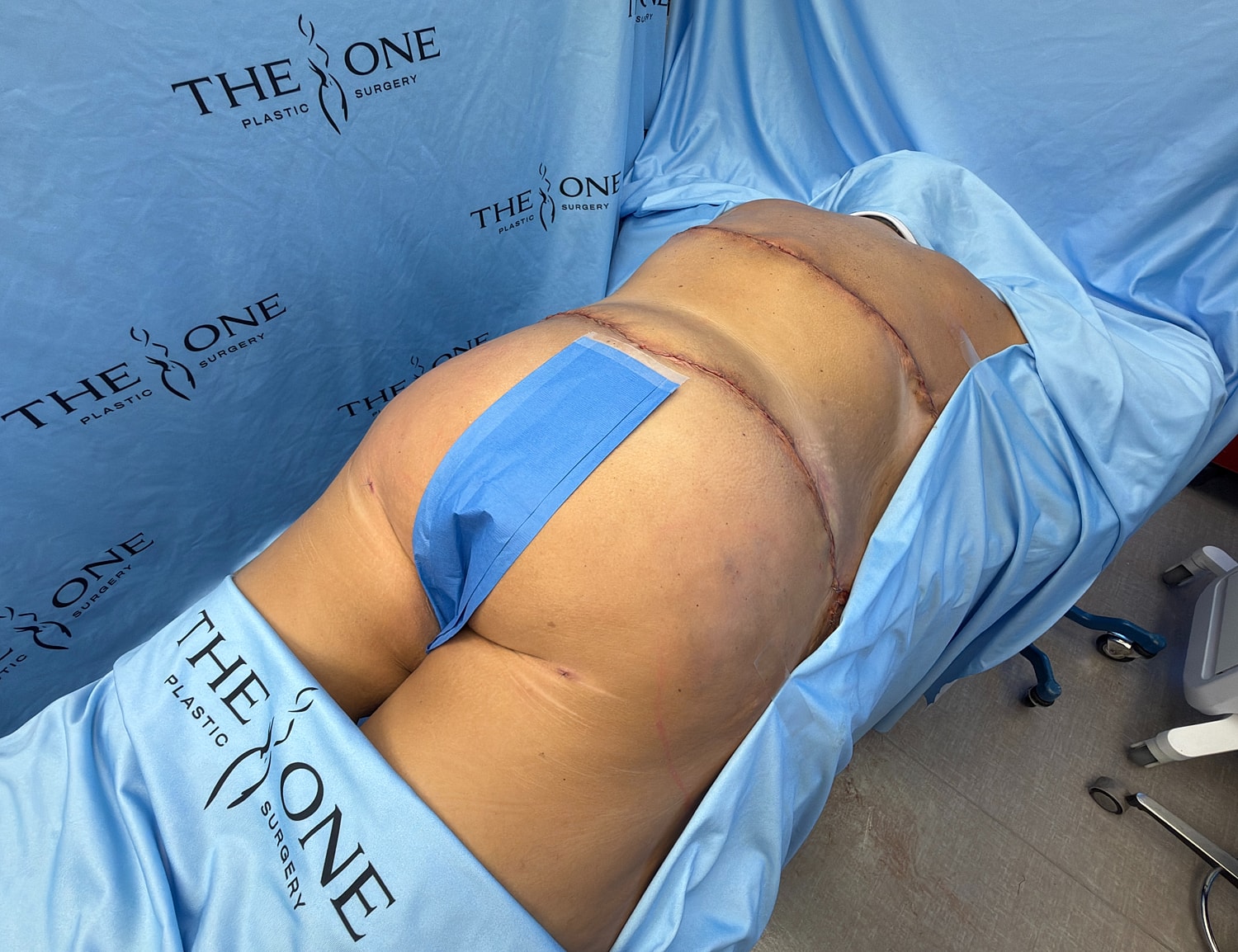Post-surgery recovery after plastic surgery procedure.