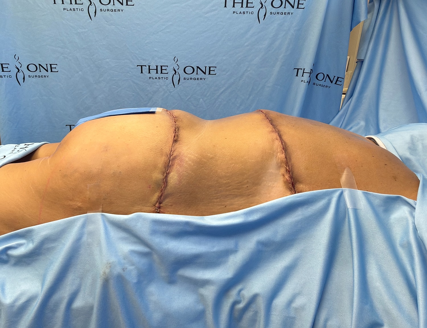Post-surgery view of a patient’s back.