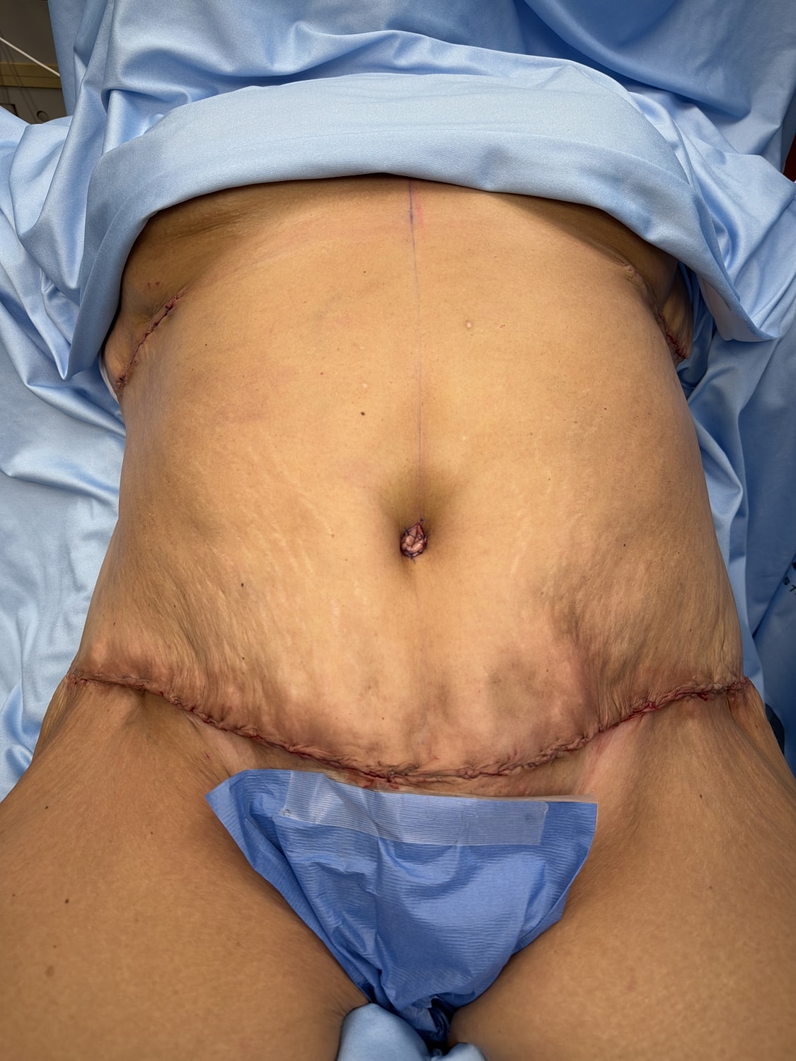 Post-surgical abdomen with visible stitches and scarring.