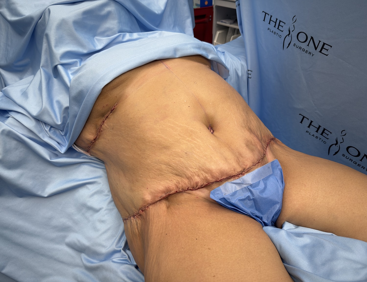 Post-operative view of abdominal surgery site.