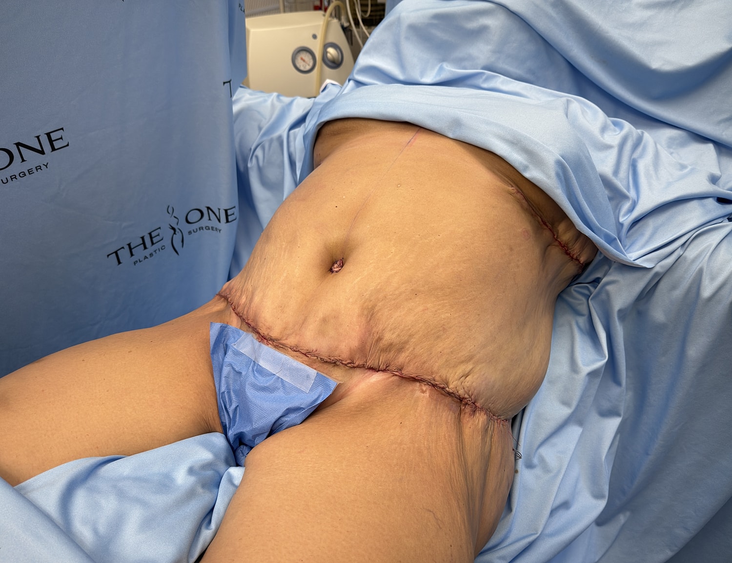 Post-surgery view of abdomen with incisions.