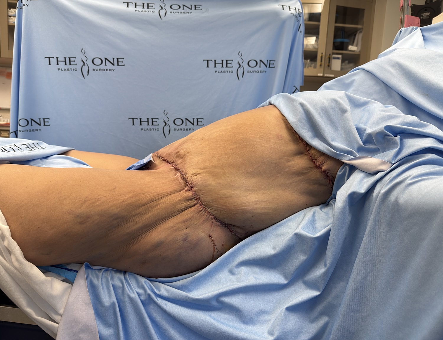 Surgical site after plastic surgery procedure.