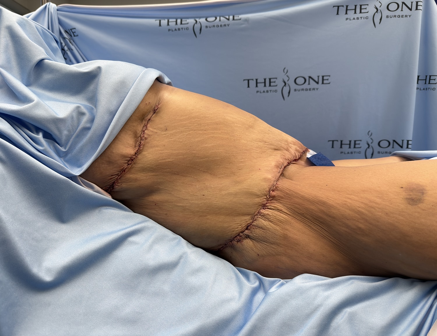 Surgical incision on leg post-operation.