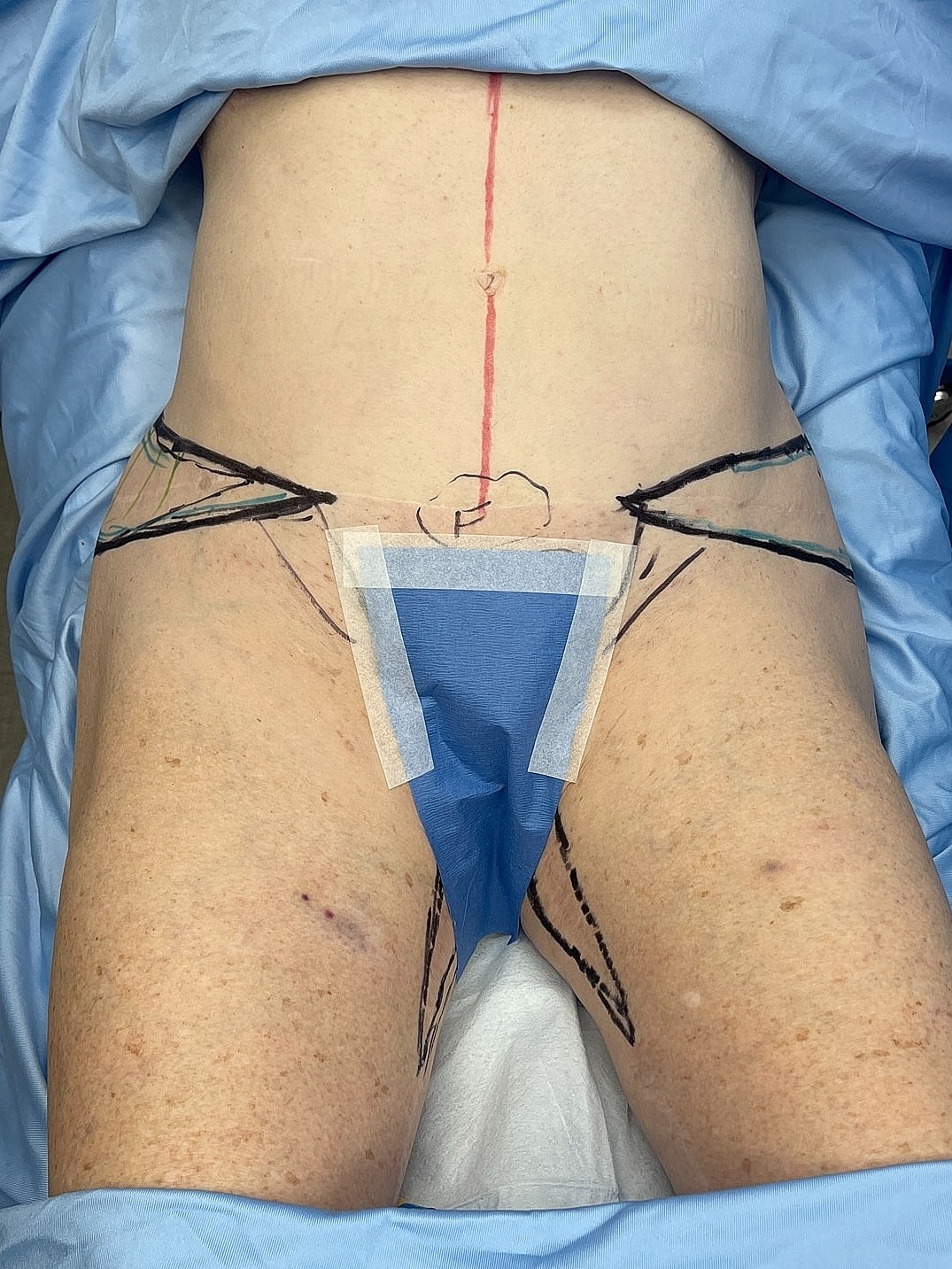 Patient preparing for a surgical procedure.