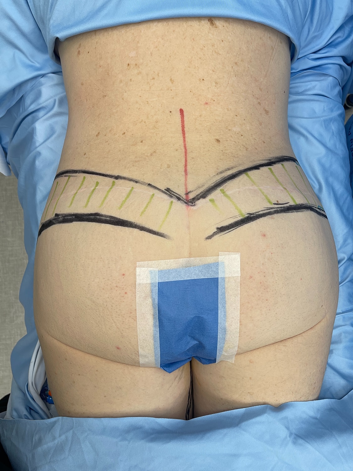 Marked skin for a medical procedure.