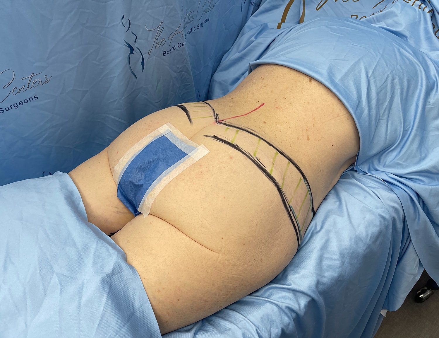 Patient prepared for surgical procedure with markings.