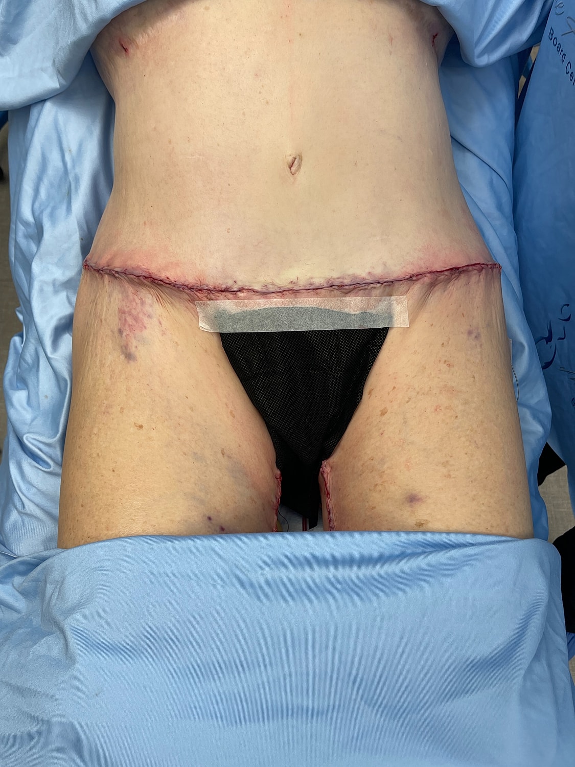 Post-surgical abdomen with stitches and dressing.