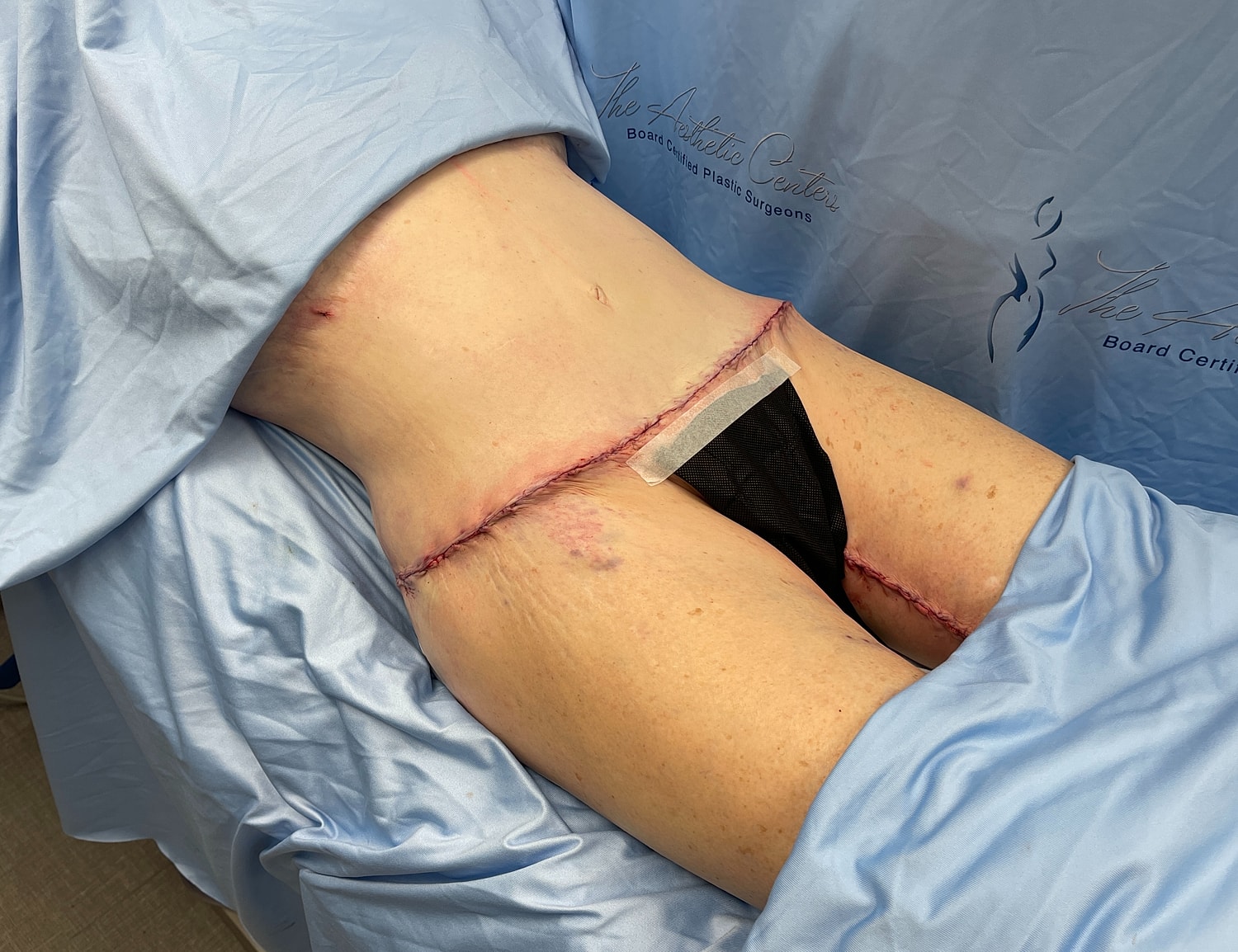Surgical stitches on a patient's abdomen post-operation.