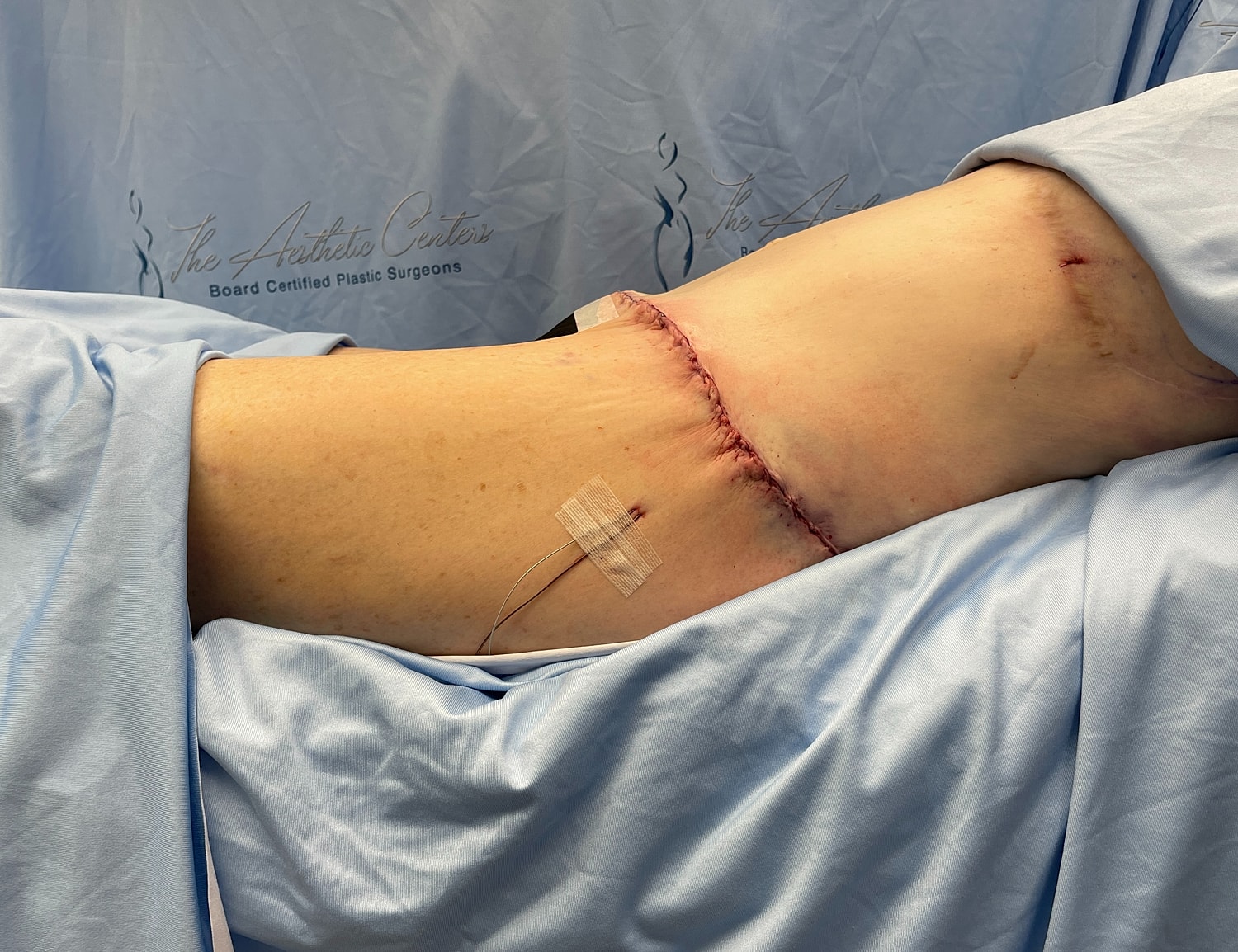 Surgical site with stitches and bandages visible.