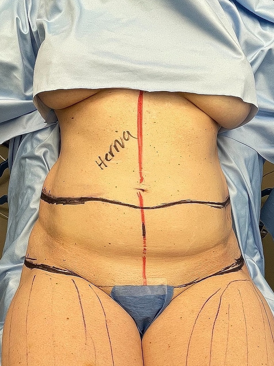 Patient marked for surgical procedure on abdomen.