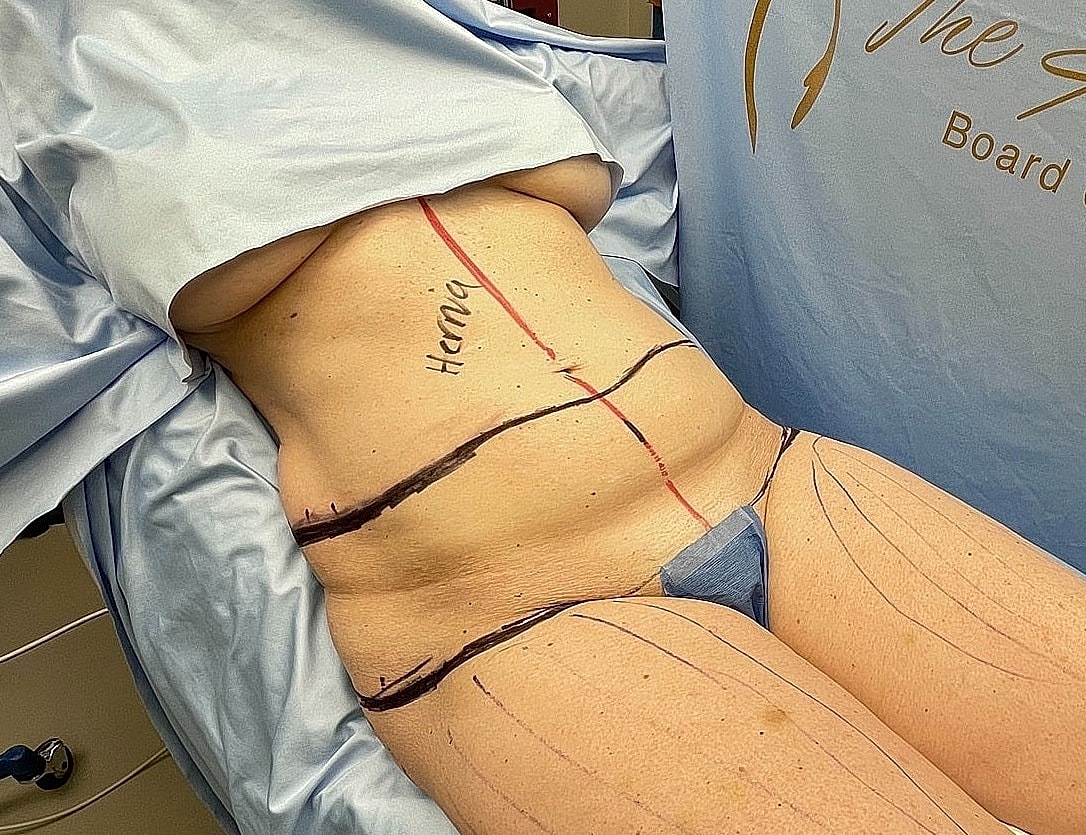 Pre-operative markings on patient's abdomen and legs.