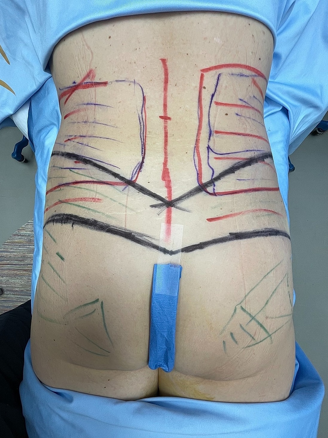 Marked back for surgical procedure preparation.