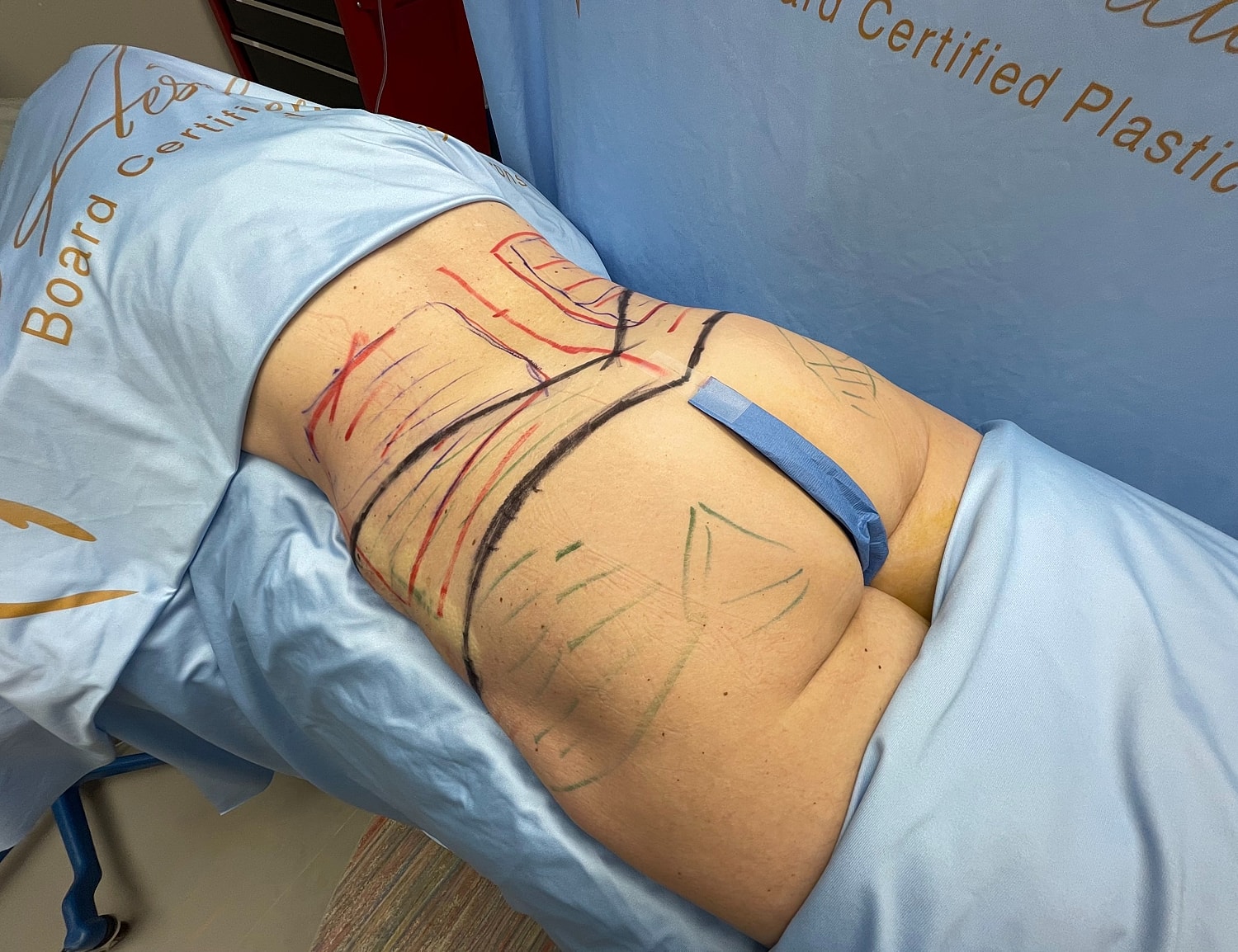 Body markings prior to a cosmetic procedure.