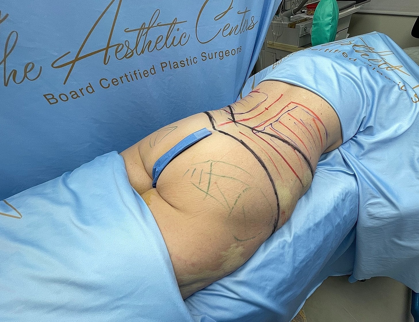 Patient preparing for cosmetic surgery procedure illustration.