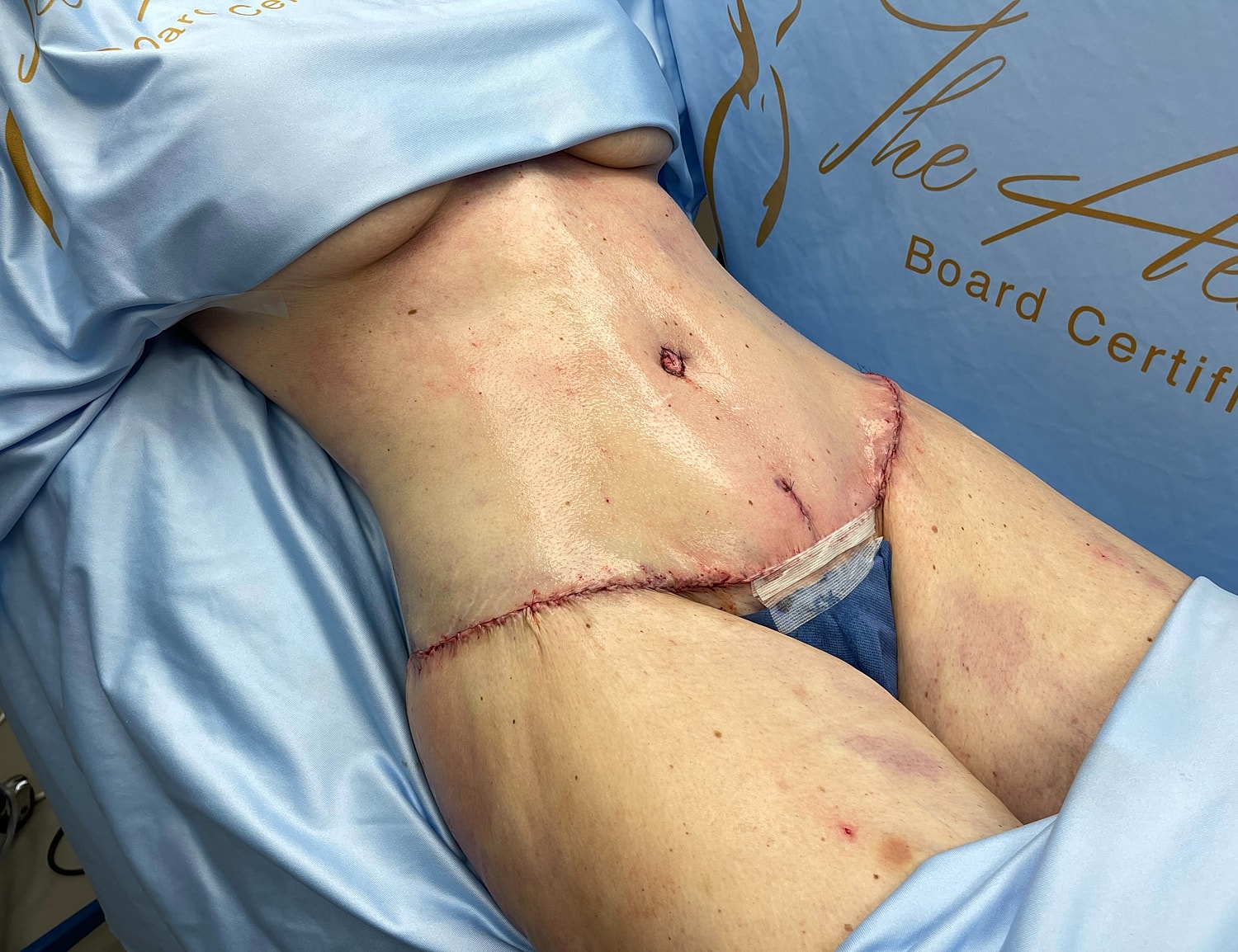 Post-surgical abdomen with visible sutures and bruising.