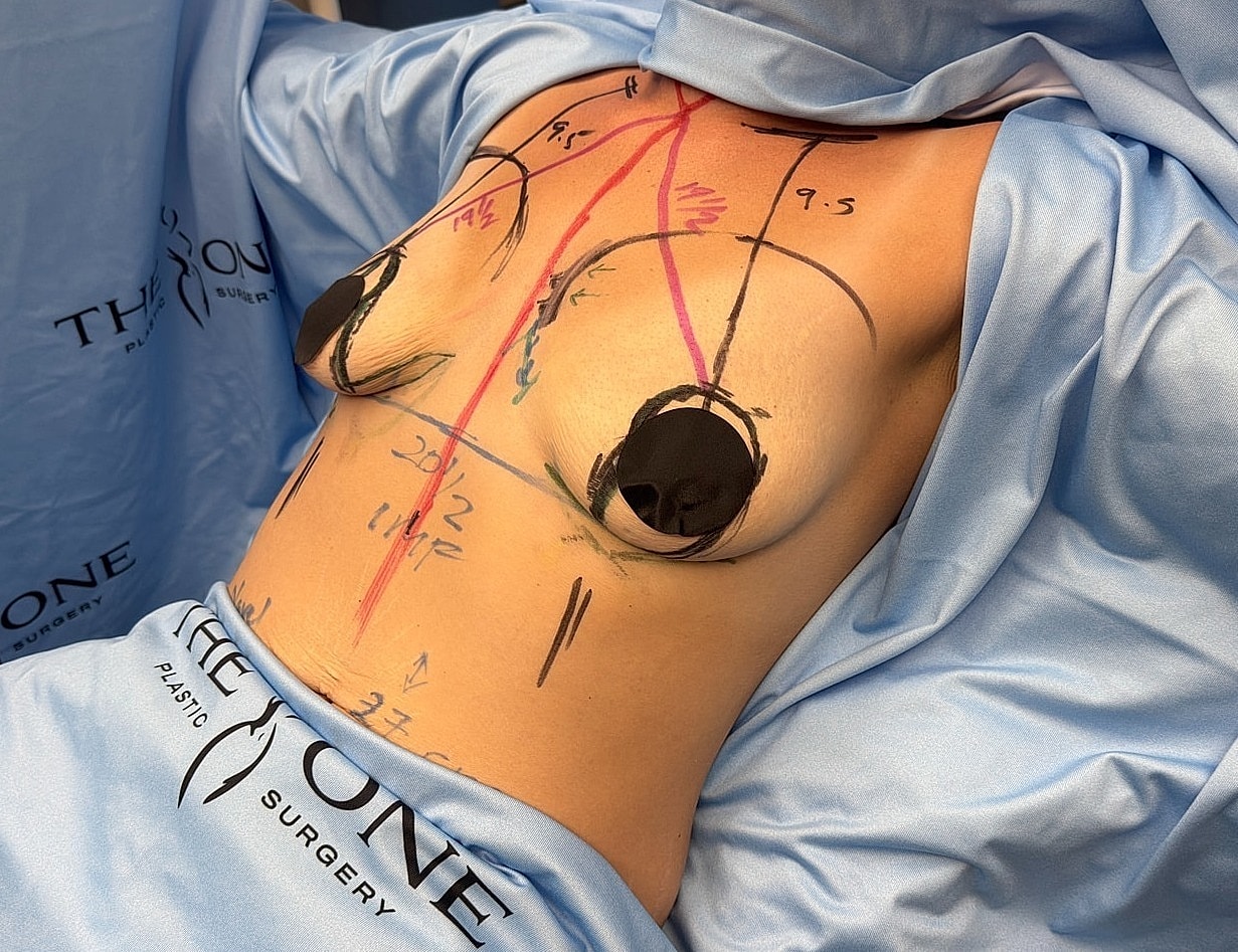 Pre-surgery body markings for breast procedure.