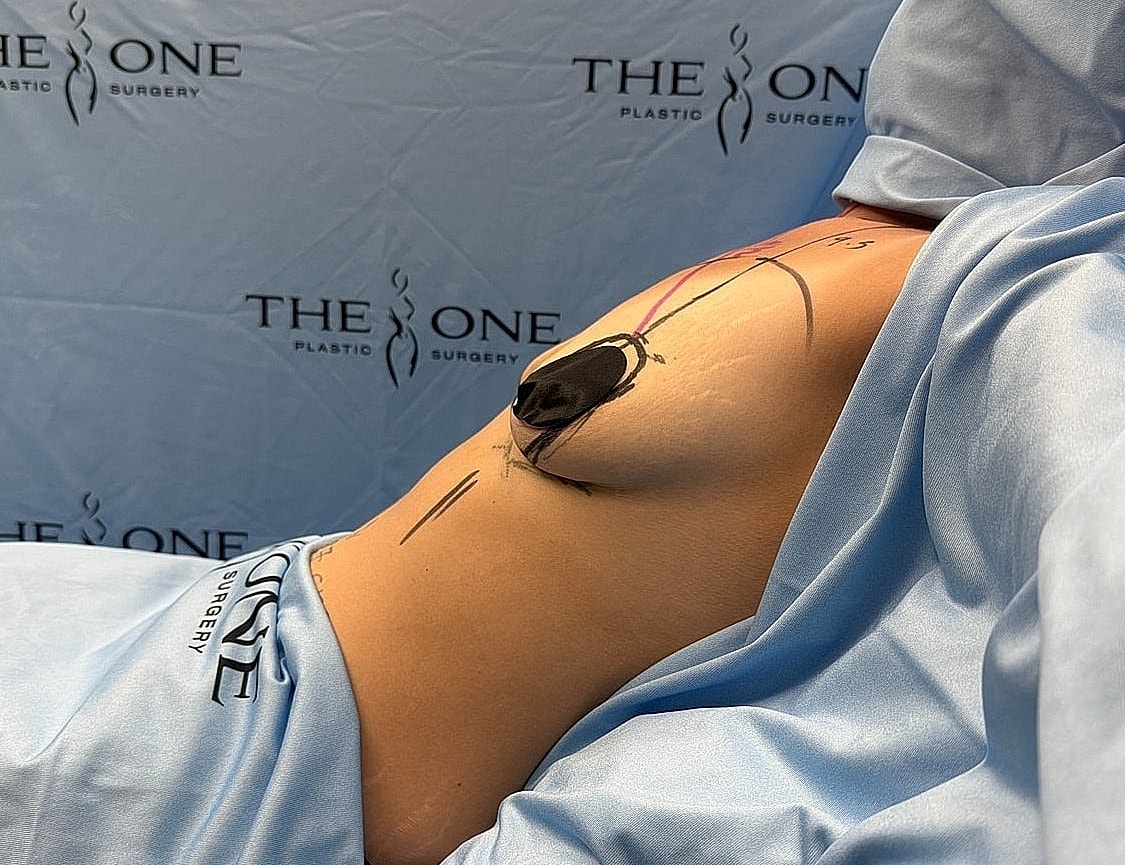 Patient preparing for plastic surgery procedure.